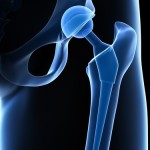 hip implant recall