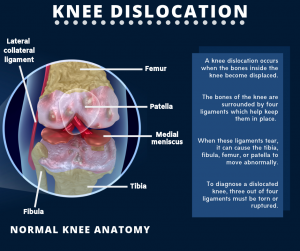 knee dislocation settlements